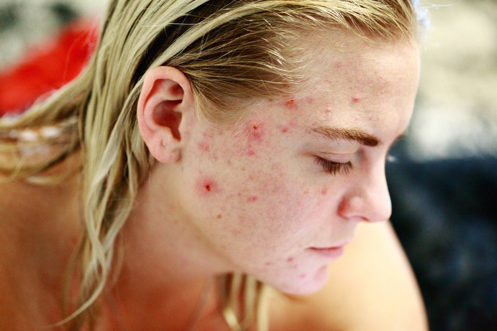 Les facteurs favorisant l’acné